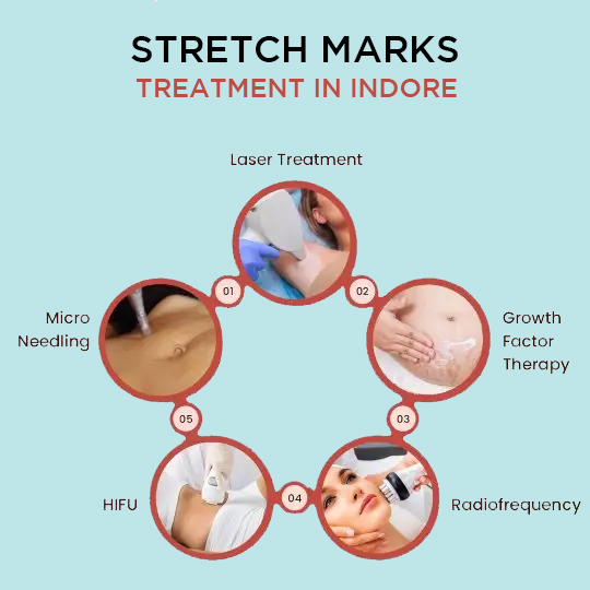 Stretch Marks Treatment in Indore
